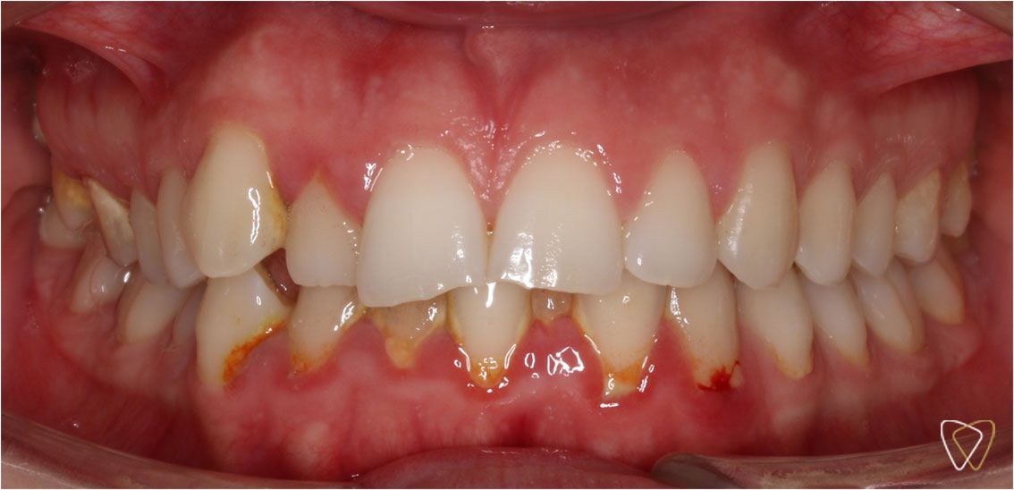 Ortodoncia Invisalign antes